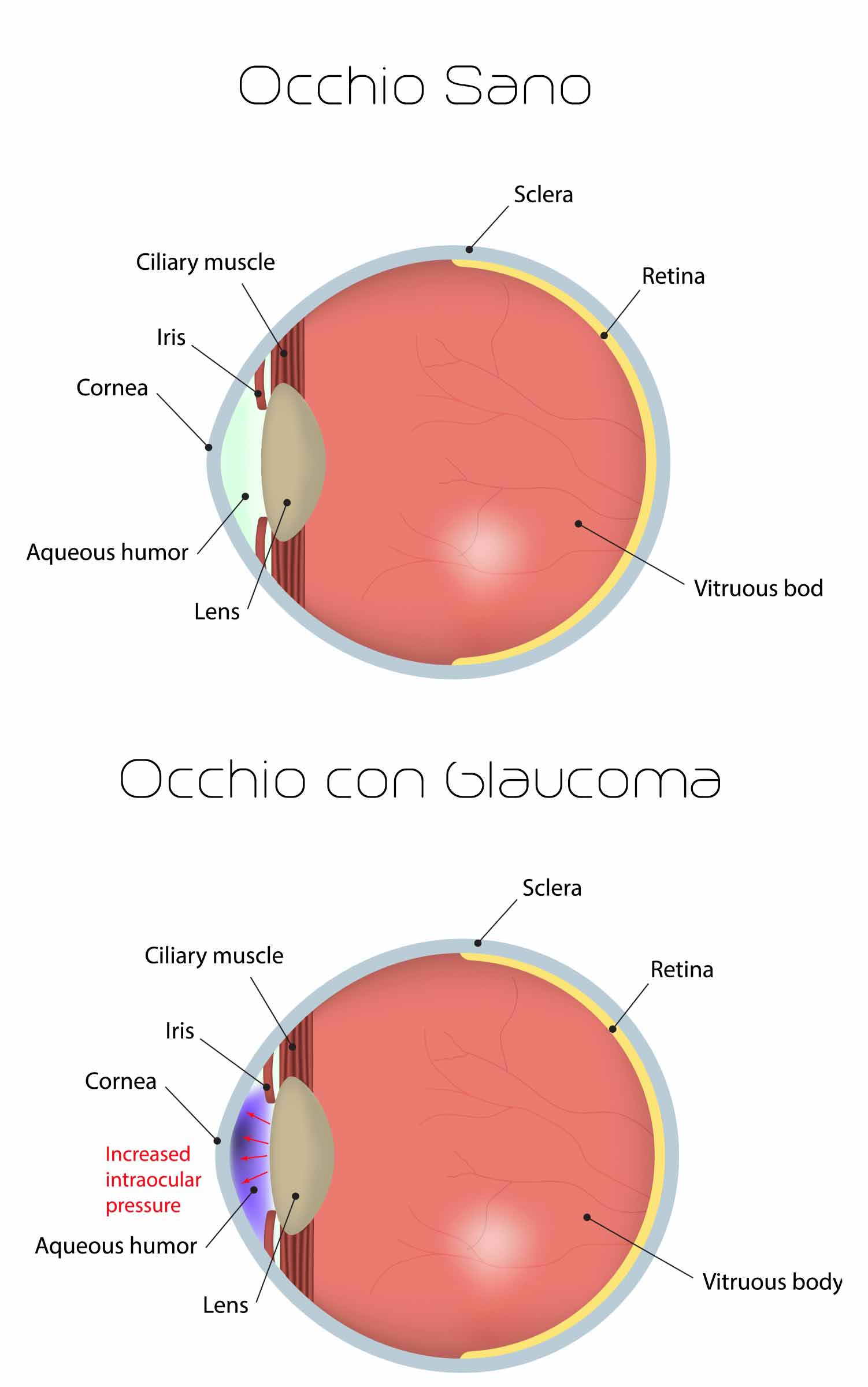 Cos'è il Glaucoma